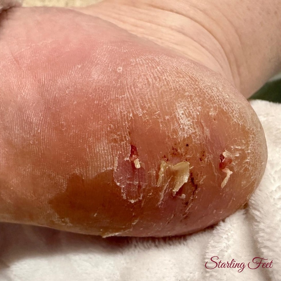 Starlingfeet
