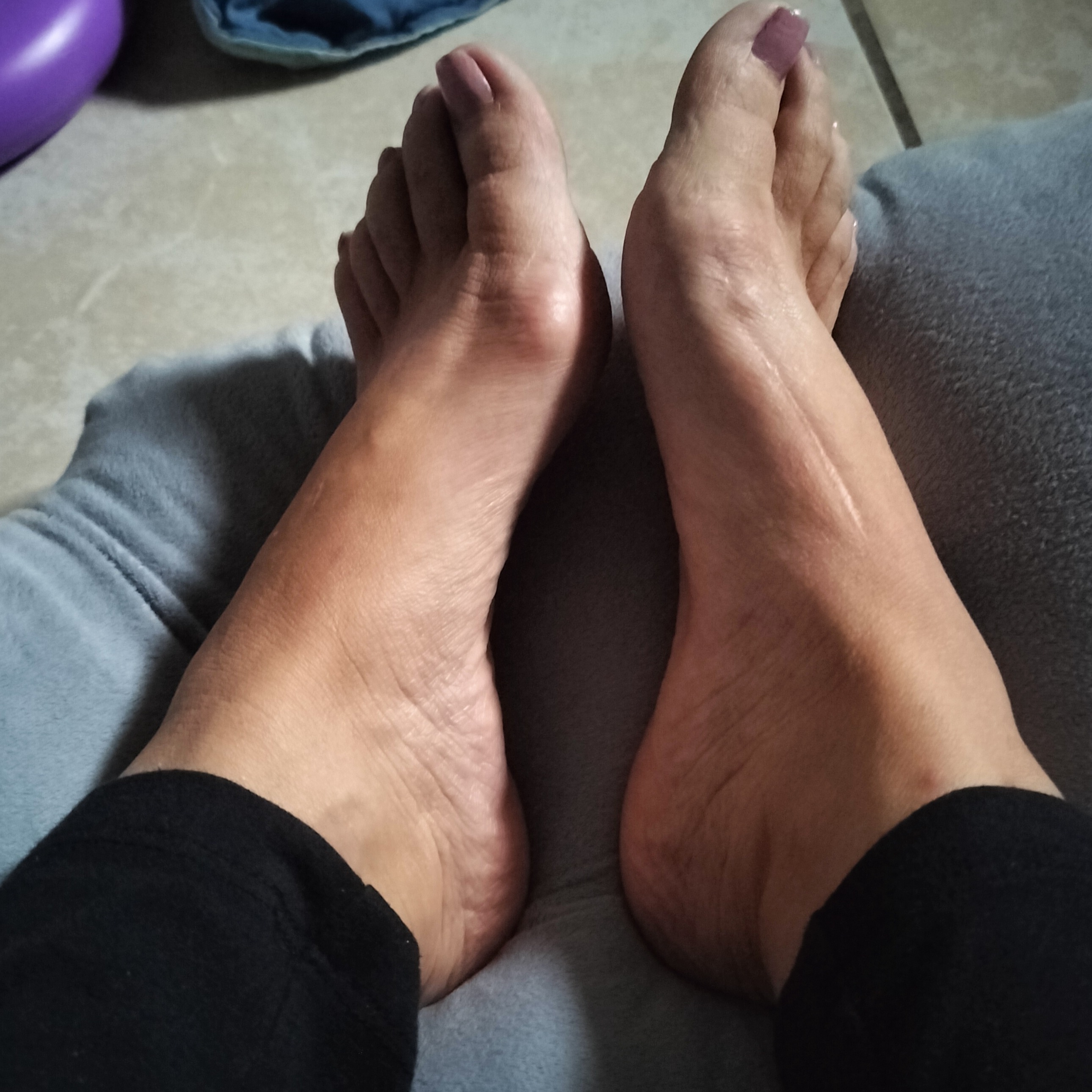 beachbunions